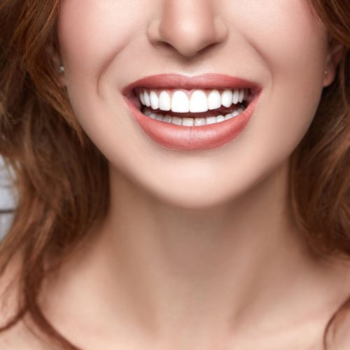 Veneers